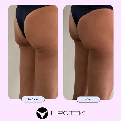 Liposhorts™ Kształtuj swoje nogi i pośladki